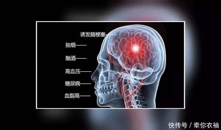 导致冬季“脑梗”高发的四大原因,你中招了吗