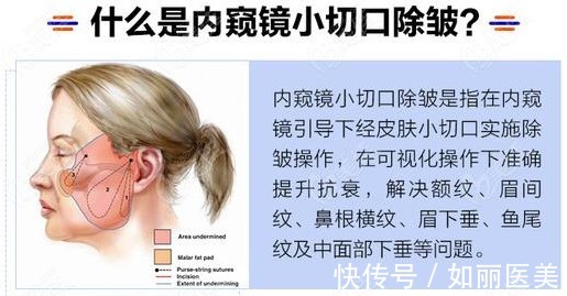 治疗 手术除皱多少钱,怎么做?效果咋样?超全抗衰攻略助你摆脱年龄数字!