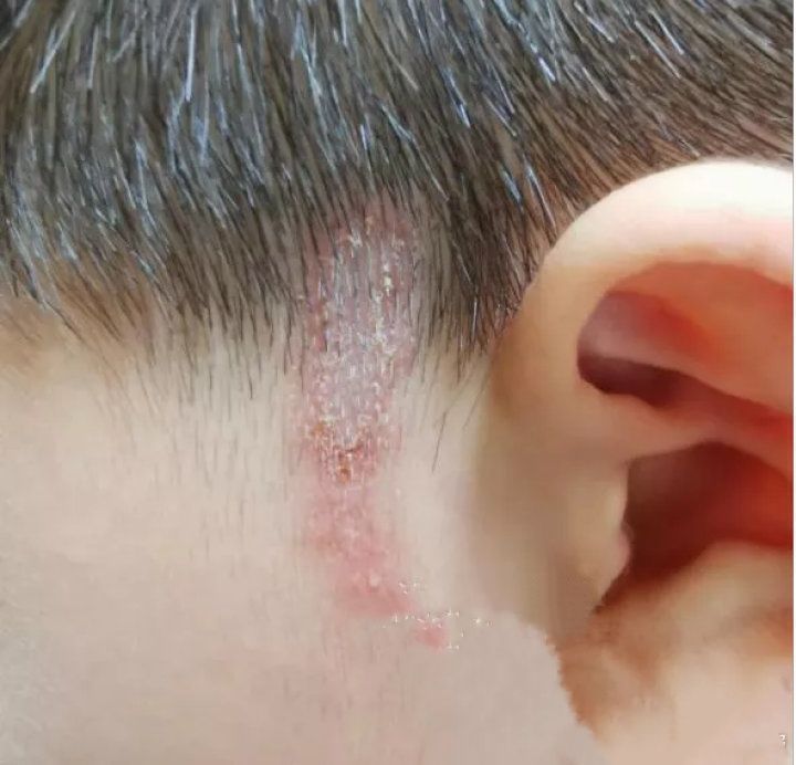 ph值|6岁男孩只因惹了这个小家伙脸部皮肤溃烂。麻烦就在“举手之间”