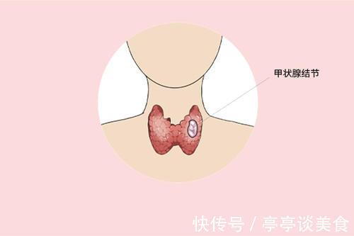 小李|甲状腺长了结节?想要缩小结节,3种食物来帮忙,你吃对了吗?