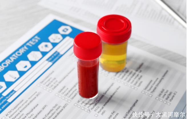  肾病|肾病不可只看尿蛋白不想耽误病情，有4项指标最好快点弄清楚