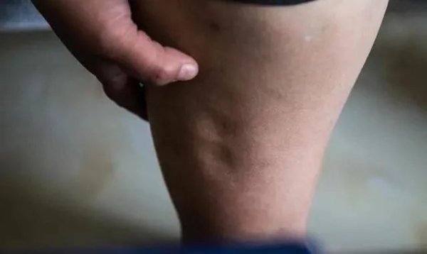尿酸高的人,睡觉往往有5种表现,若都没有,说明身体还算健康