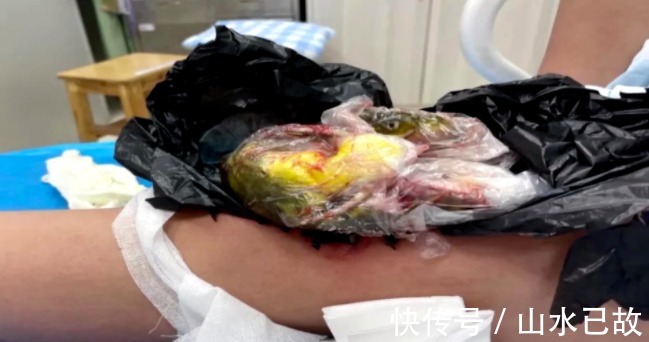 惠阳三和医院|别边走路边玩手机了!一孕妇低头玩手机撞墙,鱼骨扎进大腿8cm