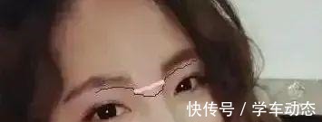 眉骨处 医美避坑理性变美,五大理由拒绝假体眉弓骨!