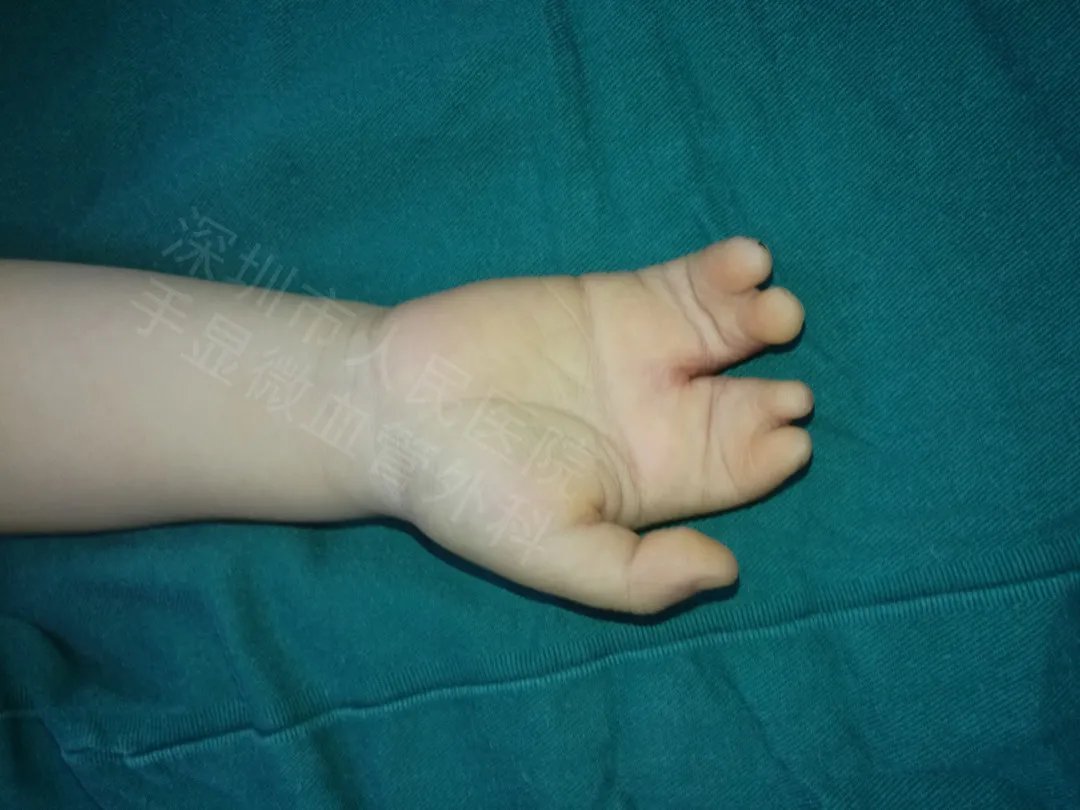 发育不良|得了这病，12岁男孩手指比香蕉还粗！7种常见的手部畸形，家长们要注意