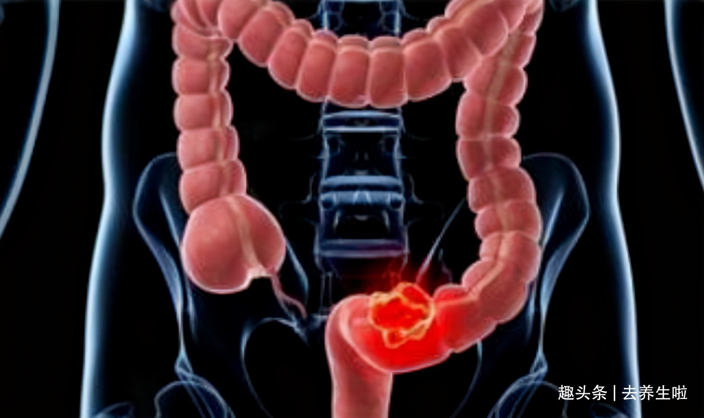 肠道|放屁很多不是肠癌！消化科医生提醒3个信号是关键，很多人不懂