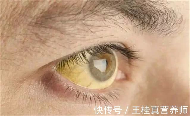 养肝护肝|身体出现2黄1痛，或是肝炎转癌的症状，医生：不可小觑