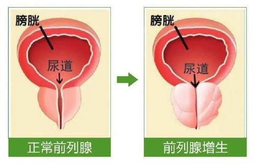  前列腺|人老了，排尿困难无需治疗？得了前列腺增生不要一拖再拖！