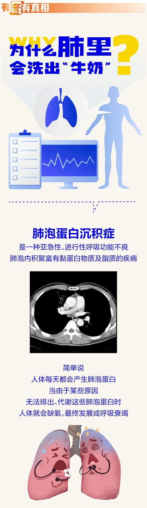 肺泡蛋白|胸闷气喘半年,男子肺里洗出19升“牛奶”