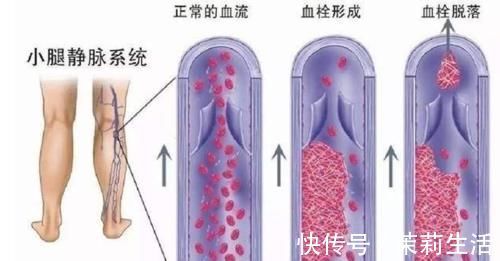 病理性|老年人总是容易脚浮肿,一定病重的征兆?真相来了