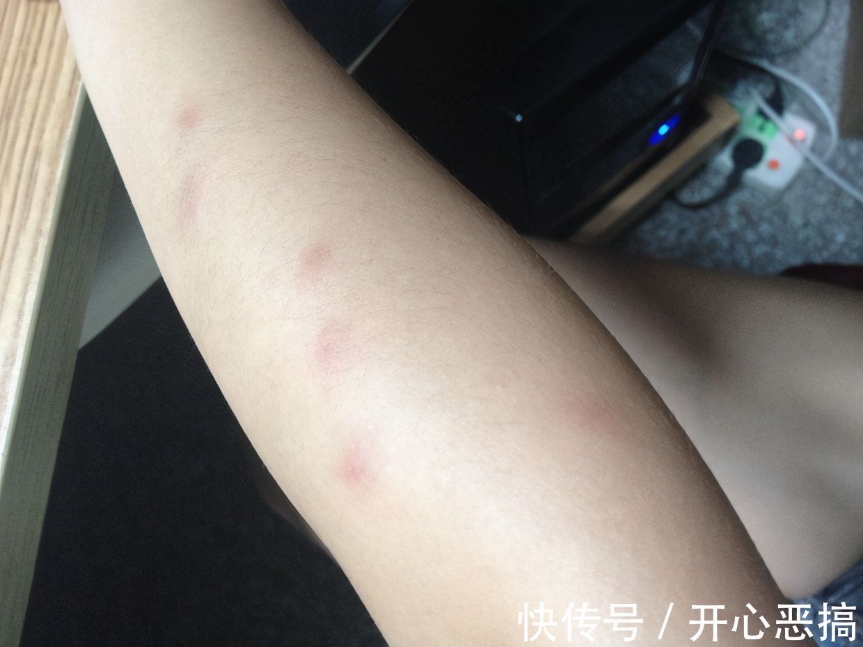 孙女|5岁孩子被“怪虫”咬,奶奶临危不乱救了孙女,医生都佩服