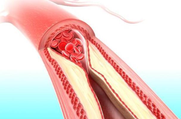 血管壁|残忍:高血压就是这样一步步“摧毁”你的!多做3事,血压能稳控