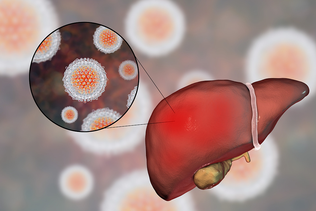  严重肝病初期“不痛不痒”！但若有8种异常，或是肝“求救”信号