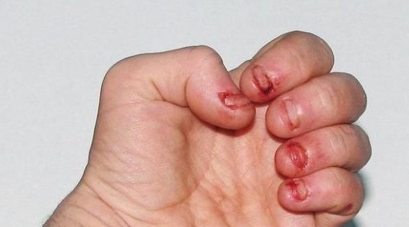 孩子|喜欢“啃指甲”的孩子,长大后会变成啥样医生逃不过两个结局