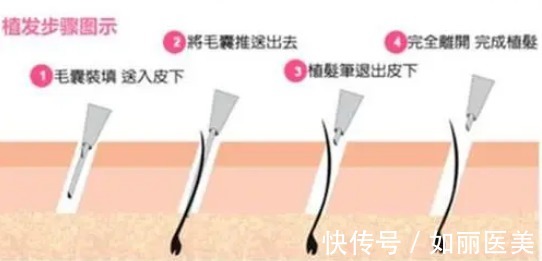 多方面 头顶植发大概需要多少个单位,多少钱?2022美发攻略教你!