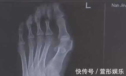 拇指 爱穿高跟鞋的女性一定要小心,拇指外翻堪比“裹脚”!不可忽视