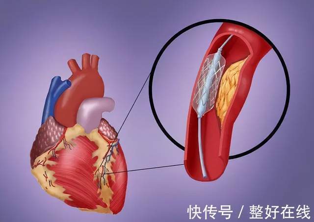 症状|什么是冠心病？冠心病的症状有哪些？常见的治疗方式是什么？