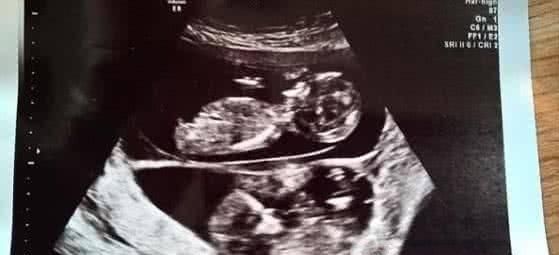 异期|女子怀孕五个月后再度怀孕,医生检查过后,丈夫顿感泣不成声