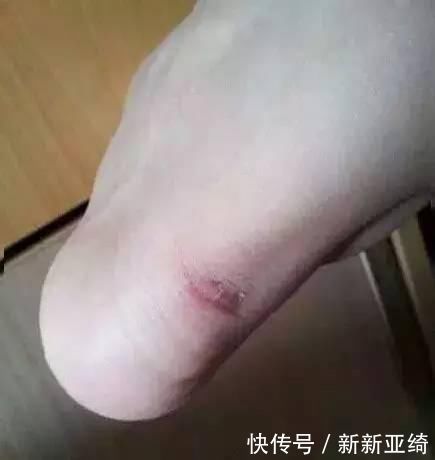 拐子|高跟鞋磨脚十种方法全搞定！终于可以美倒一整街了！