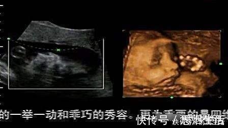 彩超|四维彩超能够预防胎儿畸形吗?四维彩超真正有6个作用,别搞错