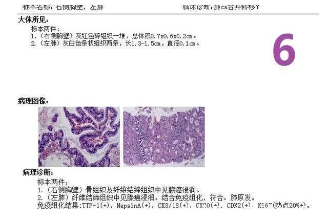 ct|如果不治疗的话,肺癌的发展速度到底有多快?