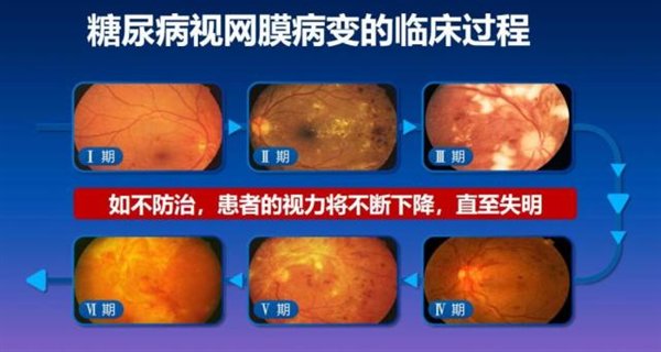 糖网|联合国糖尿病日：警惕糖尿病眼病致盲，定期眼底检查