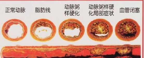 为什么这么多中国人有脑梗因为脖子上长了这个东西