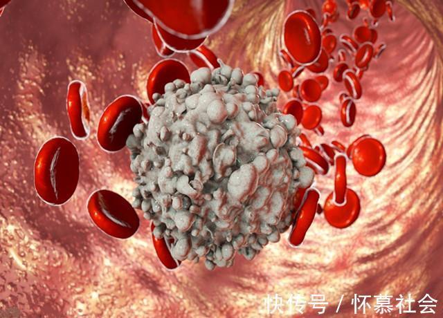 免疫细胞|国家新发现中医在癌症上的新突破, 穷人用的起的抗癌方法