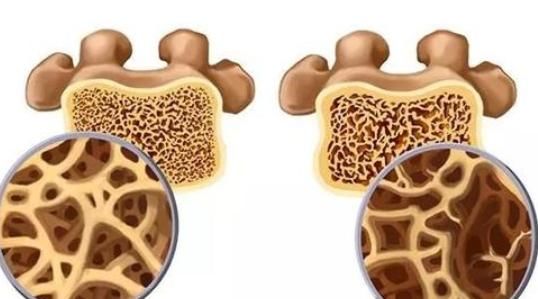 每3秒就有1人而骨折，骨科专家：教你4招应对骨质疏松！