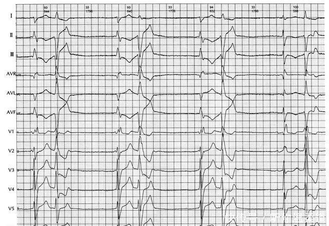  临床资料|心电图读图每日一练，提高诊断水平，第3题（含第2题答案）