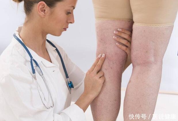  发出|体内有血栓，身体会发出6个信号，及时检查，避免血管堵塞