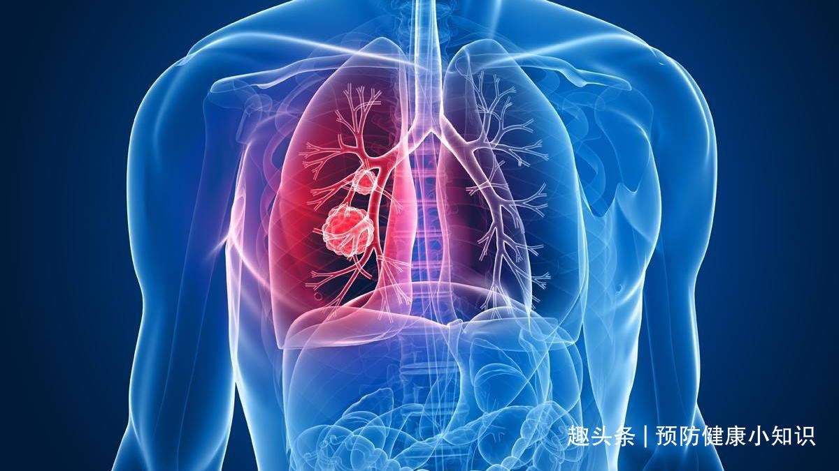 肺癌专家|治癌二十多年,肺癌专家患上肺癌,他的一个反思,引人深思