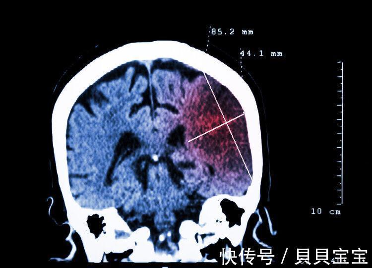 胆固醇|吃3种食物可“挡住”脑梗塞！可惜很多人不喜欢吃