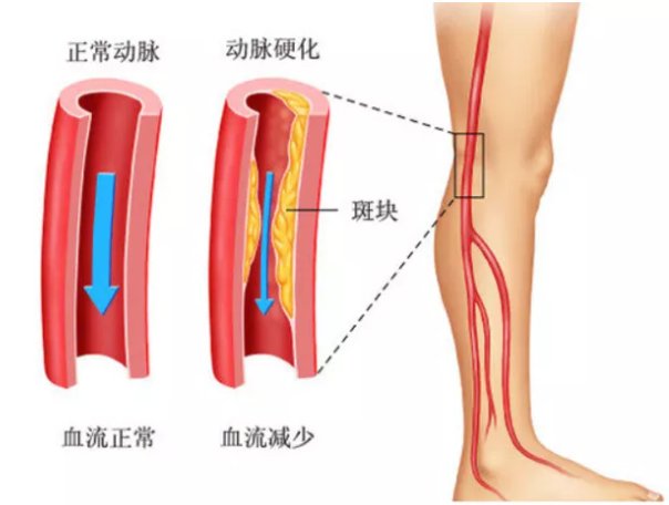 间歇性跛行|【健哥说心脏】天气寒冷，糖友们小心下肢动脉闭塞！