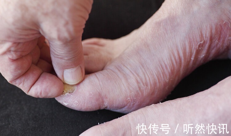 间歇性跛行|糖尿病足是每个糖友的“噩梦”!医生提醒出现4个症状就该警惕