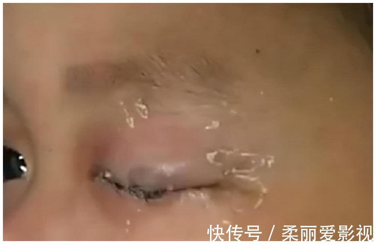 生理盐水|儿子误把502胶水滴进眼里,爸爸一举动救了娃,医生:干得漂亮