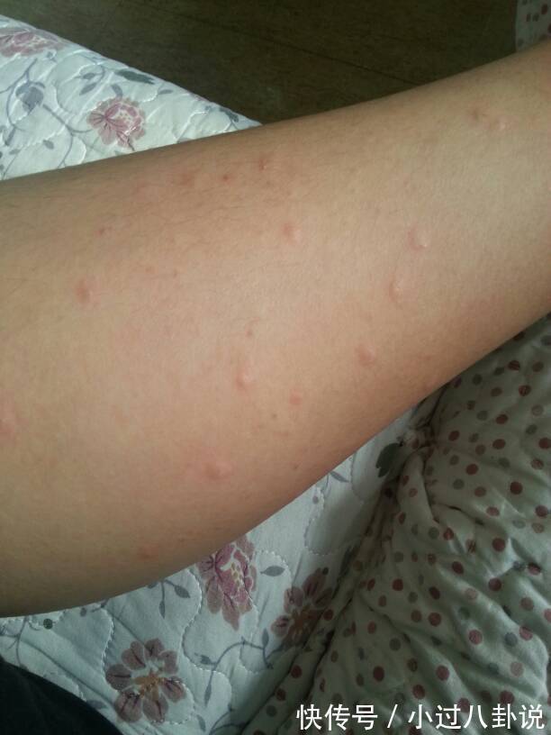 hpv感染|28岁女教师查出宫颈癌，医生：只因太像皮肤病，HPV信号都忽略了