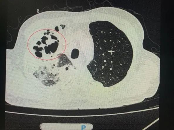 “超低价”种了颗牙，大叔住进ICU！医生提醒：吸入性肺脓肿可致命|惊 | 病原菌