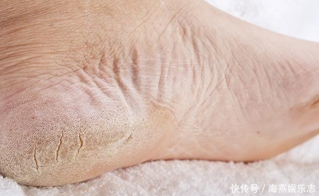 脚底|脚气一犯又臭又痒,厨房这2物专克脚气,每天用1点彻底解决脚气