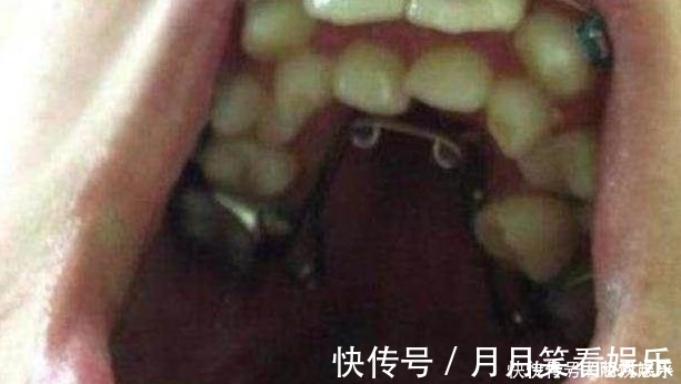 喂养|10岁男孩长出“双排牙”,父母送医检查,医生家长喂得太精细