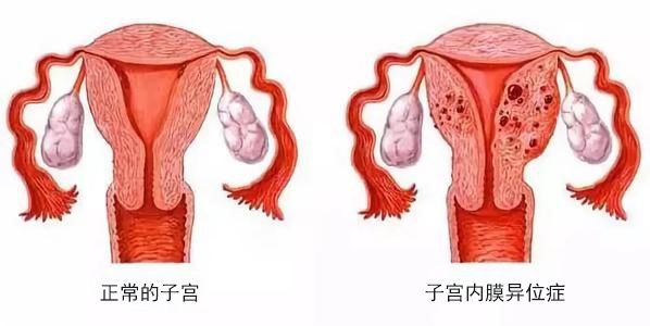 子宫|爱嗣国际∣痛经？不孕？可能是子宫内膜异位症在“搞事情”