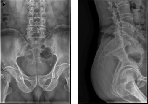 椎体|脊柱常见肿瘤及肿瘤样病变的几种影像学表现，你都见过吗？