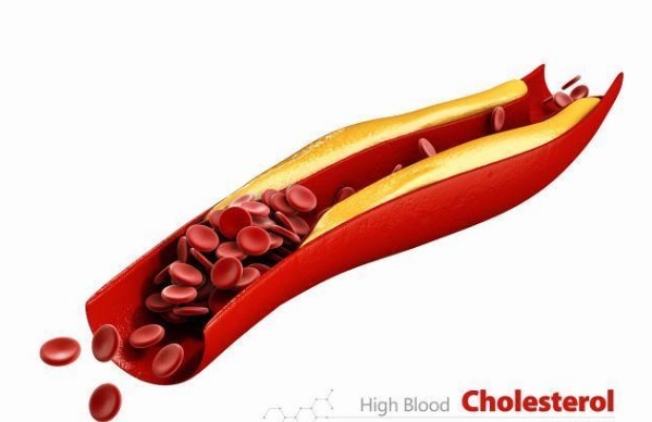 跑步|高血脂通过跑步能降下来吗要跑多久才可以本文讲出实情