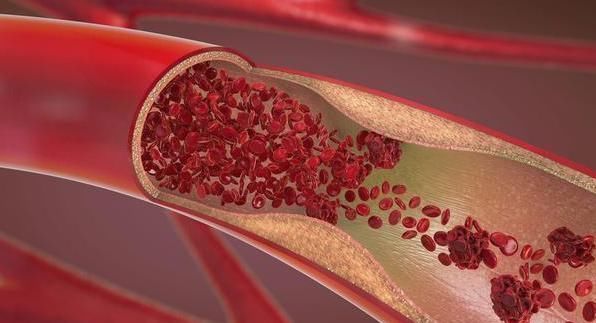 血管|低密度脂蛋白高,“死对头”就在厨房,偶尔吃点,血管不堵有弹性