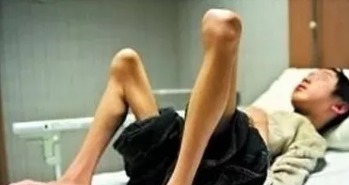 鸭步|肌营养不良能活多久?它是绝症吗