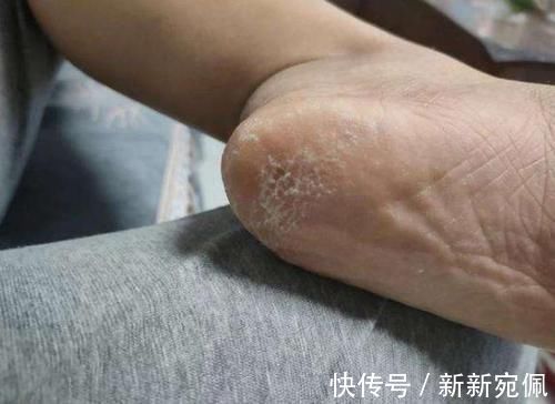 维生素|脚后跟总是干裂起皮?可能是体内疾病发出的信号,别忽视!