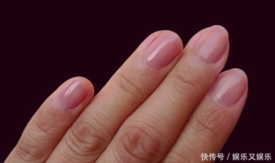 指甲上出现“竖纹”别自己瞎猜了,3个原因才是“元凶”