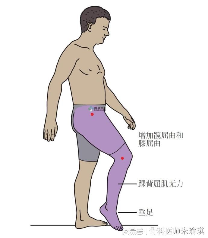 脑出血|【读报】怪异步态暗藏健康危机