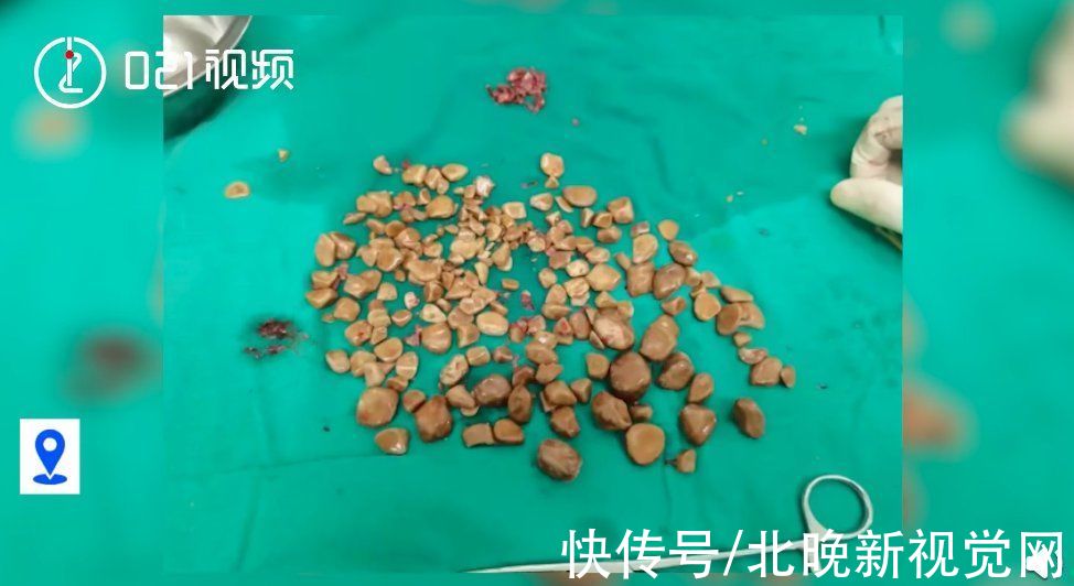 男子|可怕！上海一男子膀胱藏近200颗石子，取出耗时1个多小时