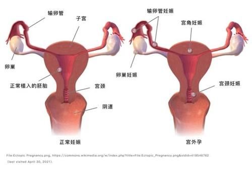 宫外孕手术后多久能上班